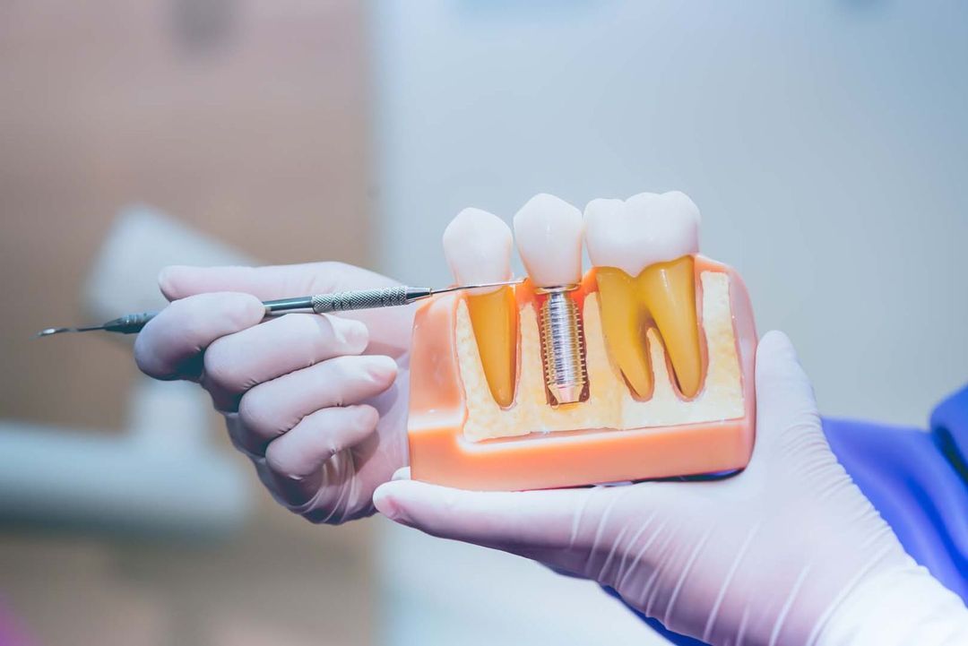 Read more about the article 10 benefits of Dental Implants